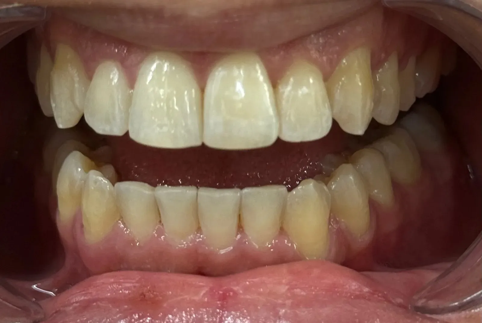 Front view after Invisalign, lower front teeth straightened into an even line