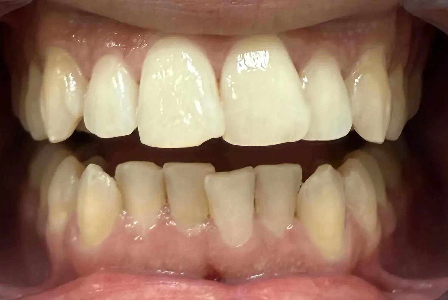 Front view of the teeth before Invisalign, lower front teeth crowded and overlapping