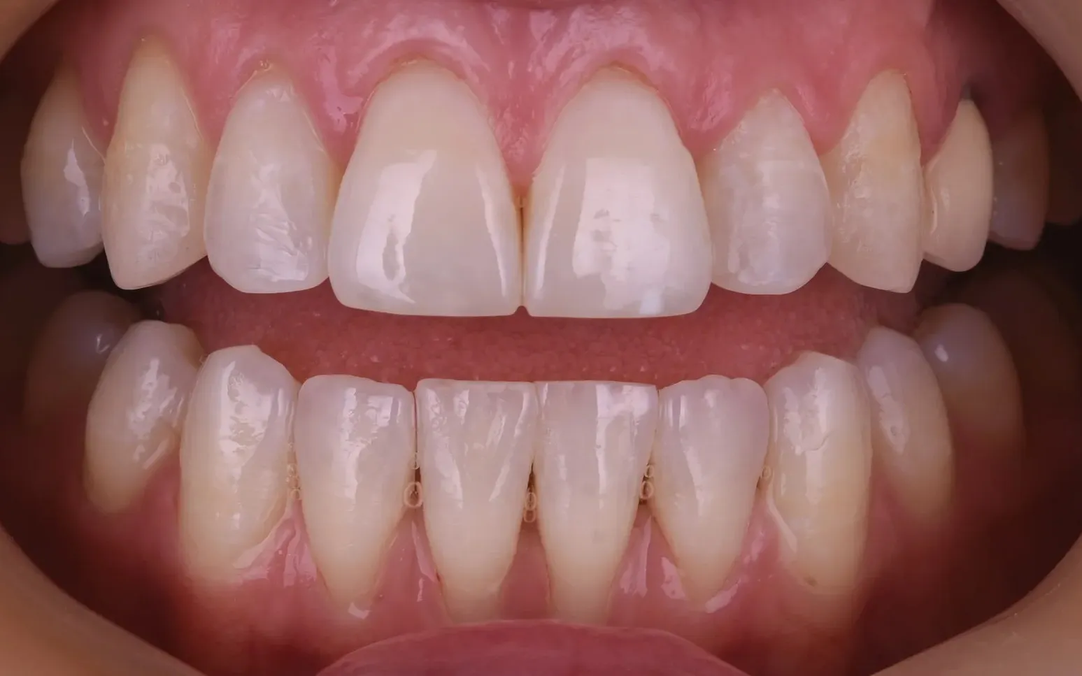 Close-up after Invisalign, upper and lower front teeth evenly aligned