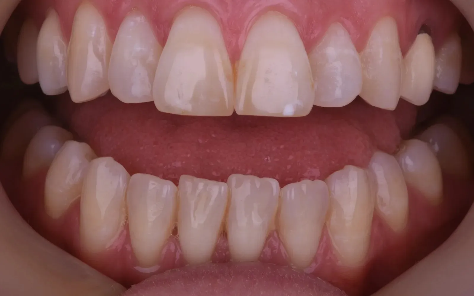 Close-up of the teeth before Invisalign, lower front teeth crowded
