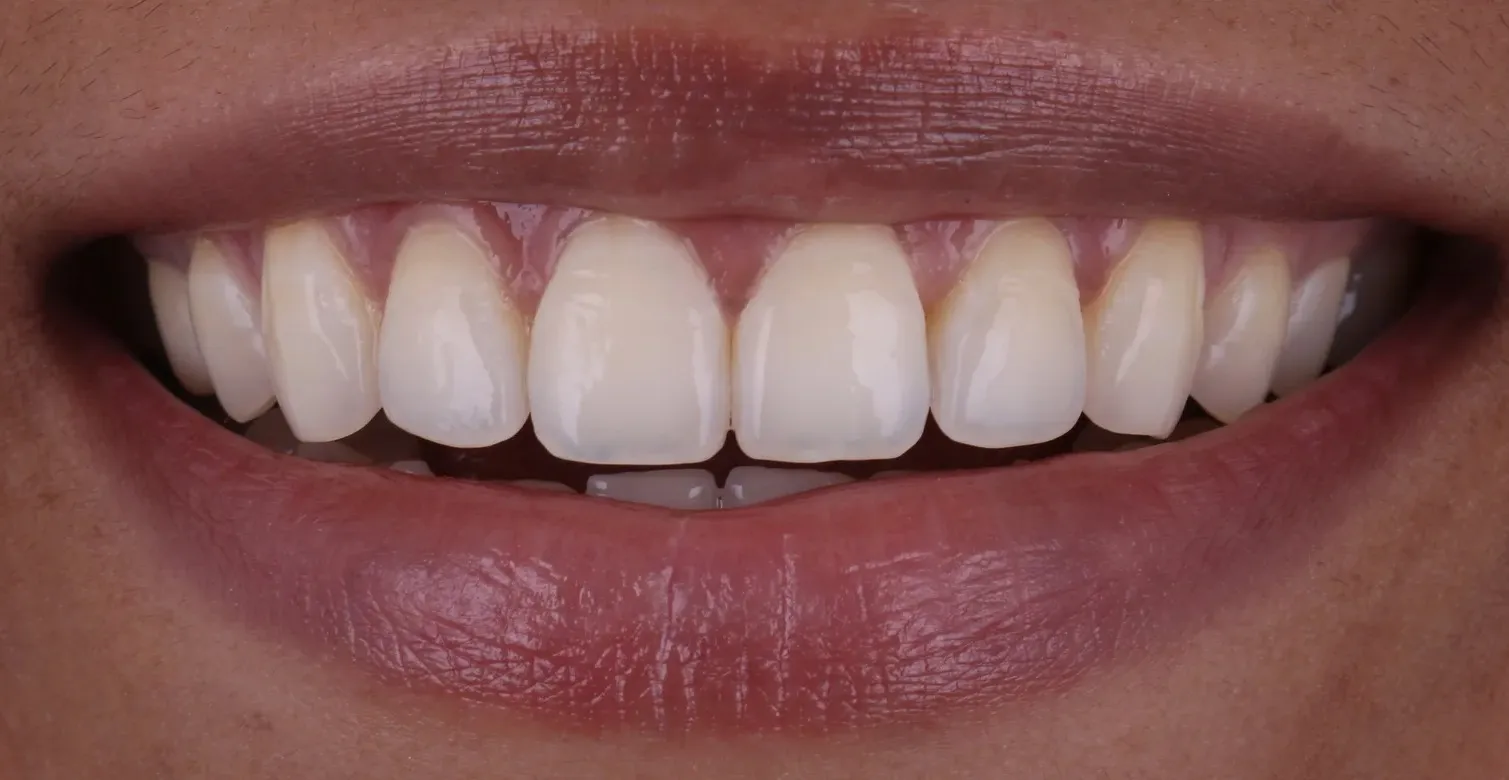 Smile after Invisalign, upper front teeth aligned in an even arch