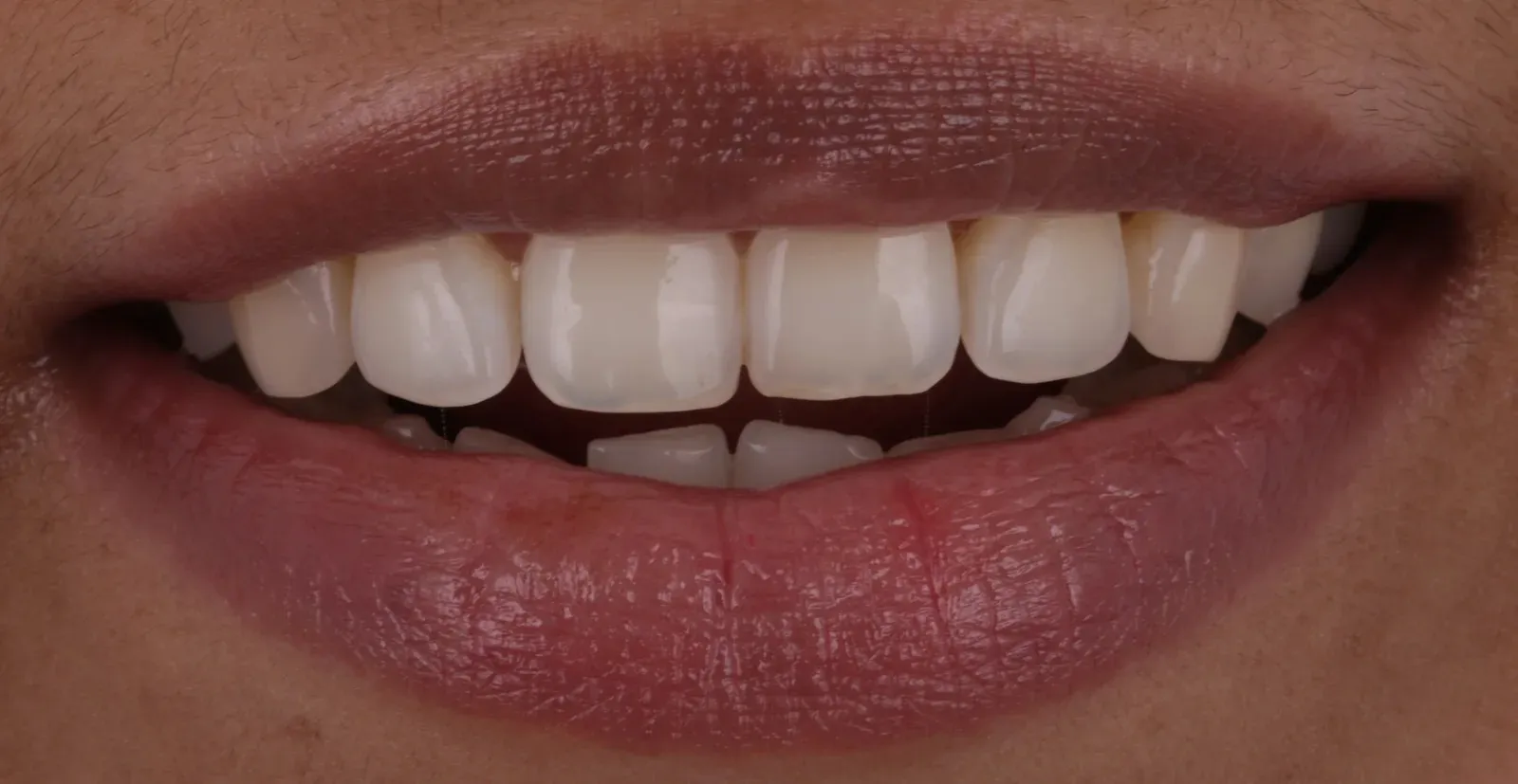 Smile before Invisalign, upper front teeth slightly turned