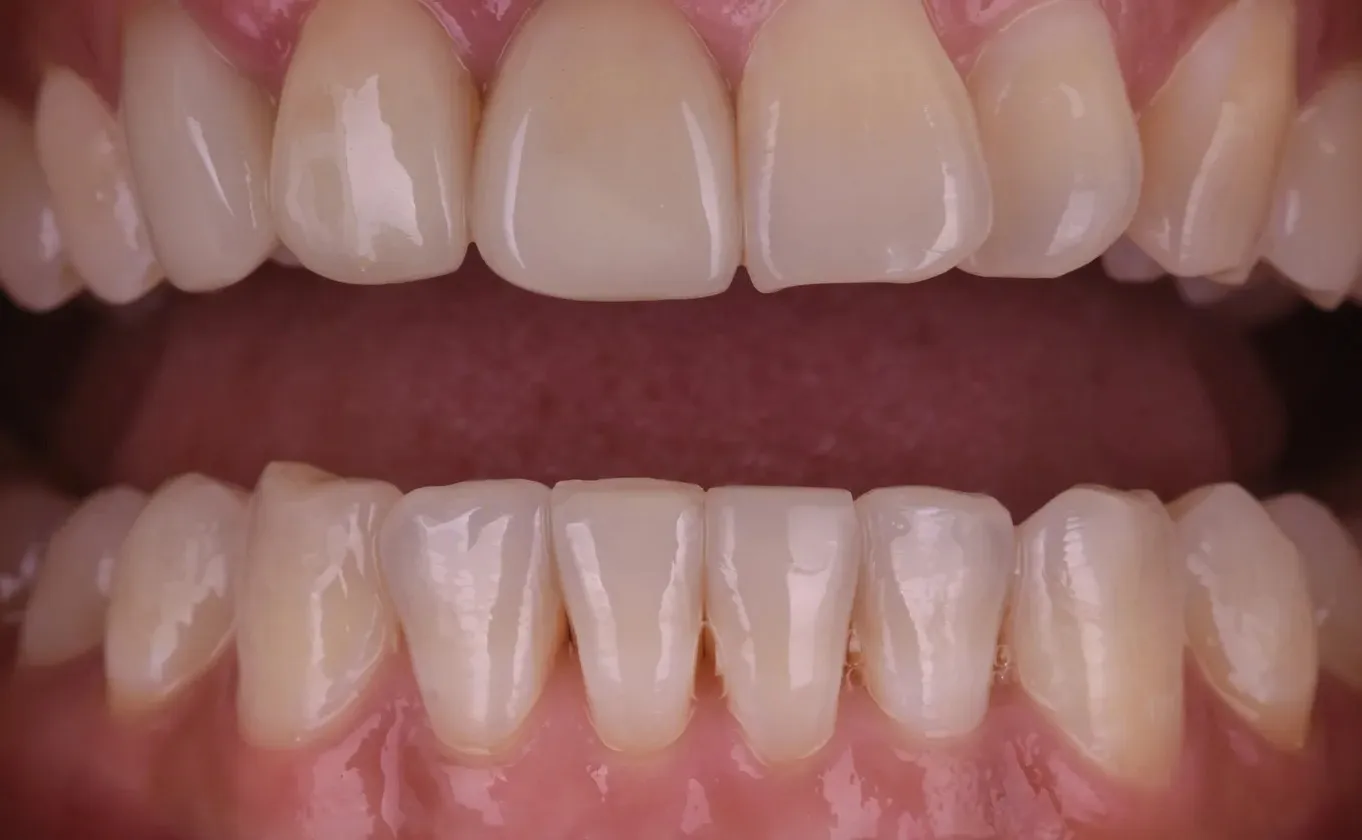 Teeth after Invisalign, lower front teeth in an even line