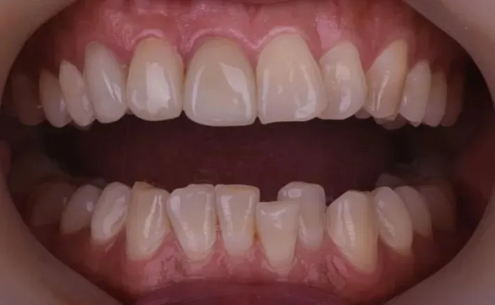Teeth before Invisalign, one lower front tooth out of line