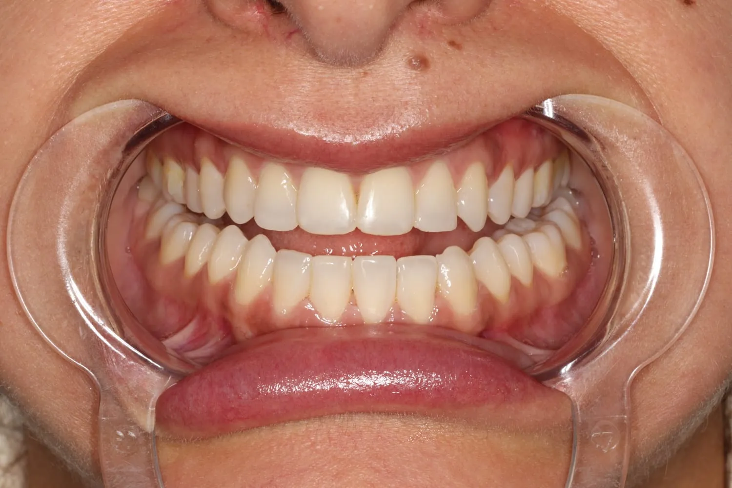 Front view of the same teeth after Invisalign, lower gaps closed and both arches evenly aligned