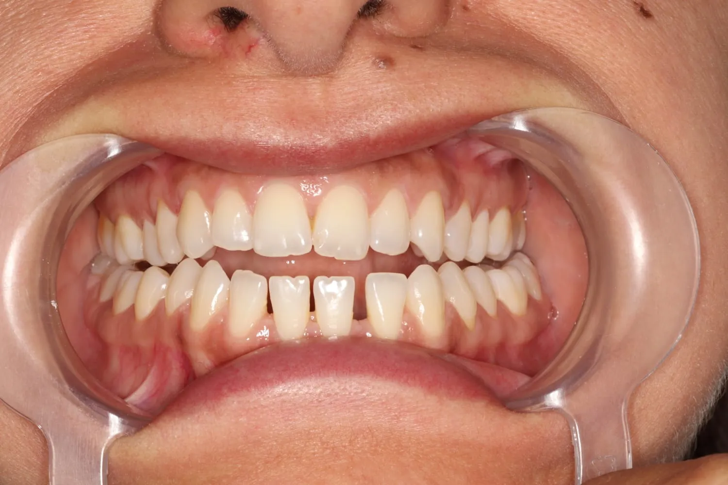 Front view of the teeth before Invisalign, with visible gaps between the lower front teeth